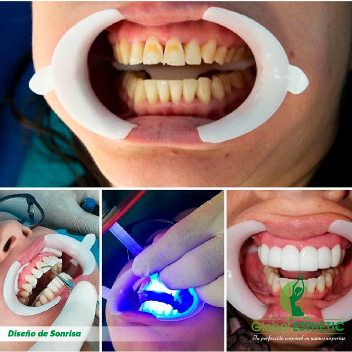 Diseño De Sonrisa Global Esthetic Cirugias