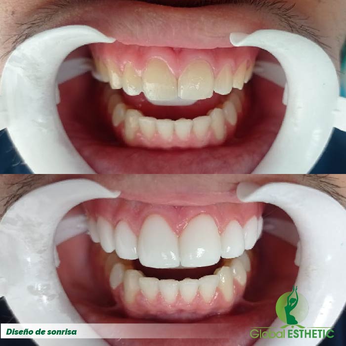 Diseño De Sonrisa Global Esthetic Cirugias